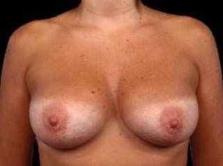 Breast Augmentation Silicone Gel Before & After Gallery - Patient 206947 - Image 2