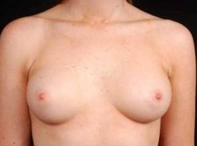 Breast Augmentation Silicone Gel Before & After Gallery - Patient 400833 - Image 1