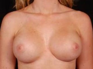 Breast Augmentation Silicone Gel Before & After Gallery - Patient 400833 - Image 2