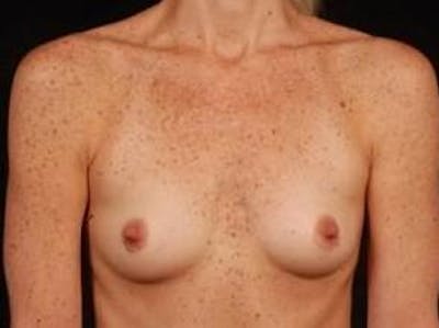 Breast Augmentation Silicone Gel Before & After Gallery - Patient 476345 - Image 1