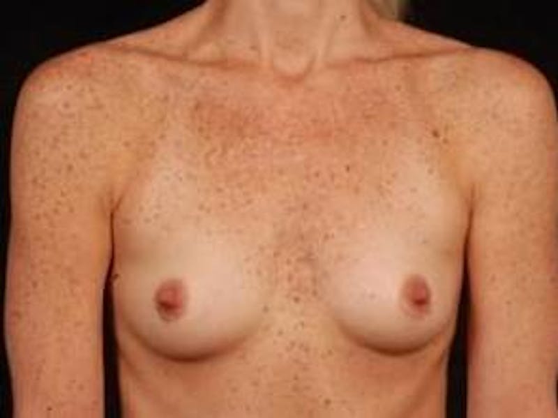 Breast Augmentation Silicone Gel Before & After Gallery - Patient 476345 - Image 1