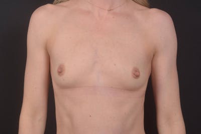 Breast Augmentation Silicone Gel Before & After Gallery - Patient 408900 - Image 1