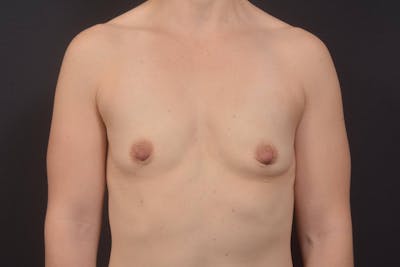 Breast Augmentation Silicone Gel Before & After Gallery - Patient 412596 - Image 1