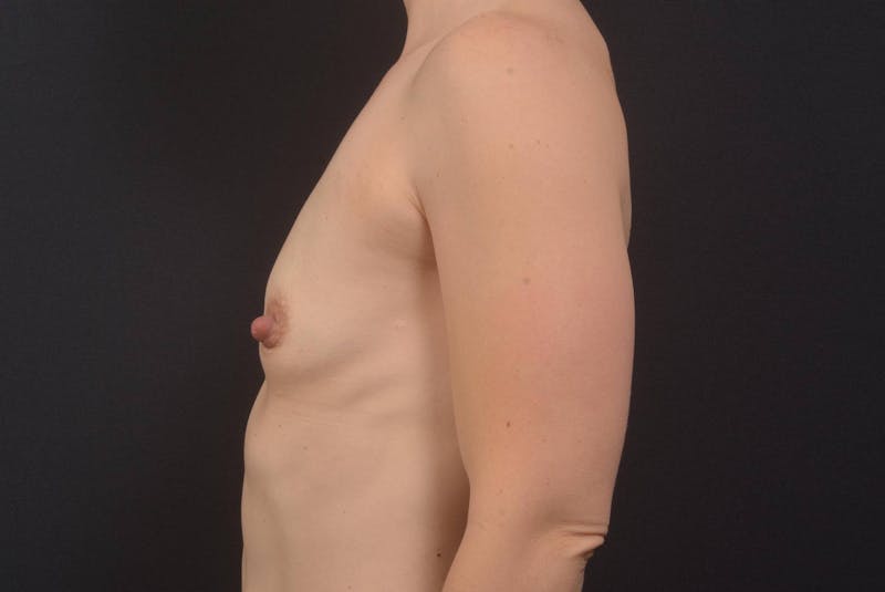 Breast Augmentation Silicone Gel Before & After Gallery - Patient 412596 - Image 3