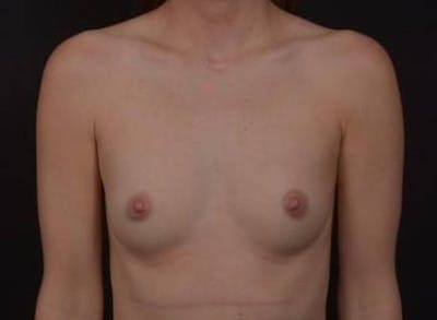 Breast Augmentation Silicone Gel Before & After Gallery - Patient 186515 - Image 1