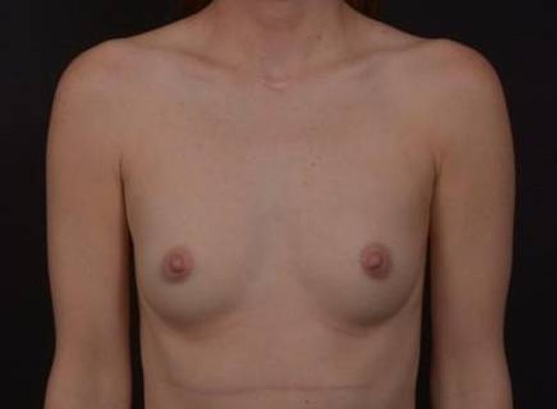 Breast Augmentation Silicone Gel Before & After Gallery - Patient 186515 - Image 1