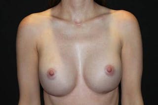 Breast Augmentation Silicone Gel Before & After Gallery - Patient 186515 - Image 2
