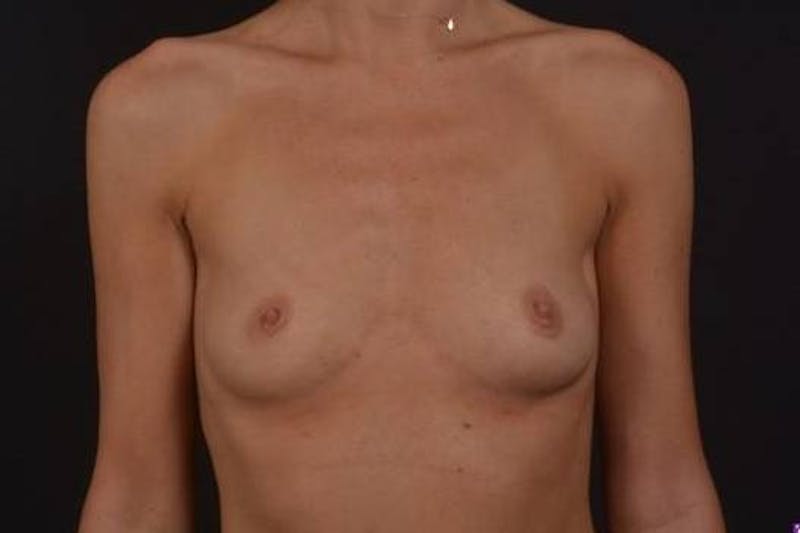 Breast Augmentation Silicone Gel Before & After Gallery - Patient 151360 - Image 1