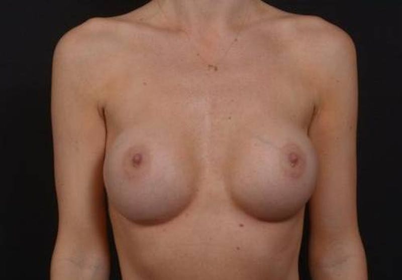 Breast Augmentation Silicone Gel Before & After Gallery - Patient 151360 - Image 2