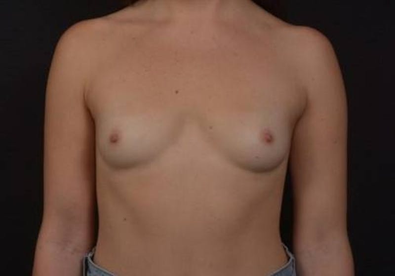 Breast Augmentation Silicone Gel Before & After Gallery - Patient 362091 - Image 1