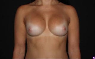Breast Augmentation Silicone Gel Before & After Gallery - Patient 362091 - Image 2