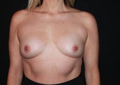 Breast Augmentation Silicone Gel Before & After Gallery - Patient 334426 - Image 1