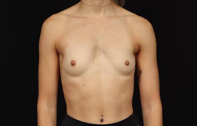 Breast Augmentation Silicone Gel Before & After Gallery - Patient 855110 - Image 1