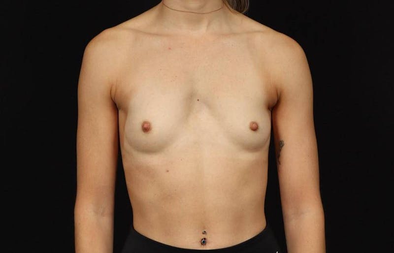 Breast Augmentation Silicone Gel Before & After Gallery - Patient 855110 - Image 1