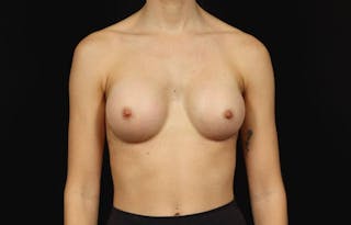 Breast Augmentation Silicone Gel Before & After Gallery - Patient 855110 - Image 2