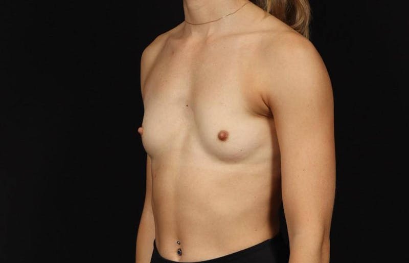 Breast Augmentation Silicone Gel Before & After Gallery - Patient 855110 - Image 3
