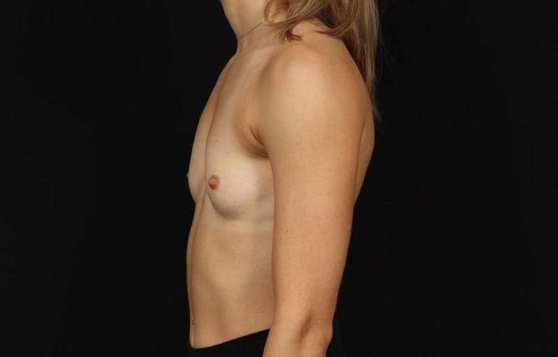 Breast Augmentation Silicone Gel Before & After Gallery - Patient 855110 - Image 5