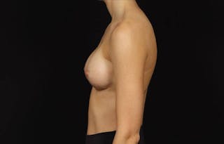 Breast Augmentation Silicone Gel Before & After Gallery - Patient 855110 - Image 6