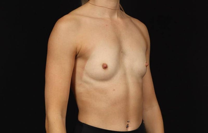 Breast Augmentation Silicone Gel Before & After Gallery - Patient 855110 - Image 7