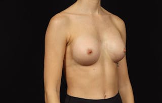 Breast Augmentation Silicone Gel Before & After Gallery - Patient 855110 - Image 8