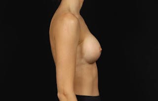 Breast Augmentation Silicone Gel Before & After Gallery - Patient 855110 - Image 10