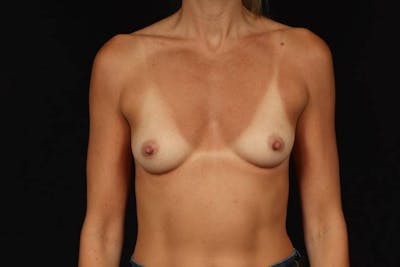 Breast Augmentation Silicone Gel Before & After Gallery - Patient 409778 - Image 1