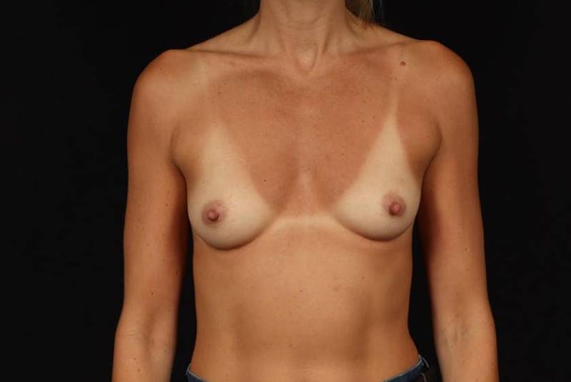 Breast Augmentation Silicone Gel Before & After Gallery - Patient 409778 - Image 1