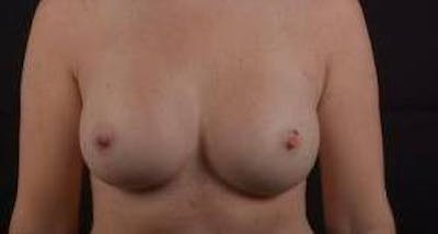 Breast Augmentation Silicone Gel Before & After Gallery - Patient 724263 - Image 2
