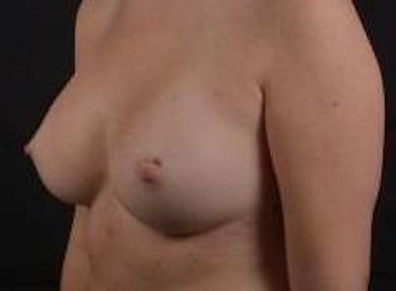 Breast Augmentation Silicone Gel Before & After Gallery - Patient 724263 - Image 8