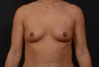 Breast Augmentation Silicone Gel Before & After Gallery - Patient 427028 - Image 1