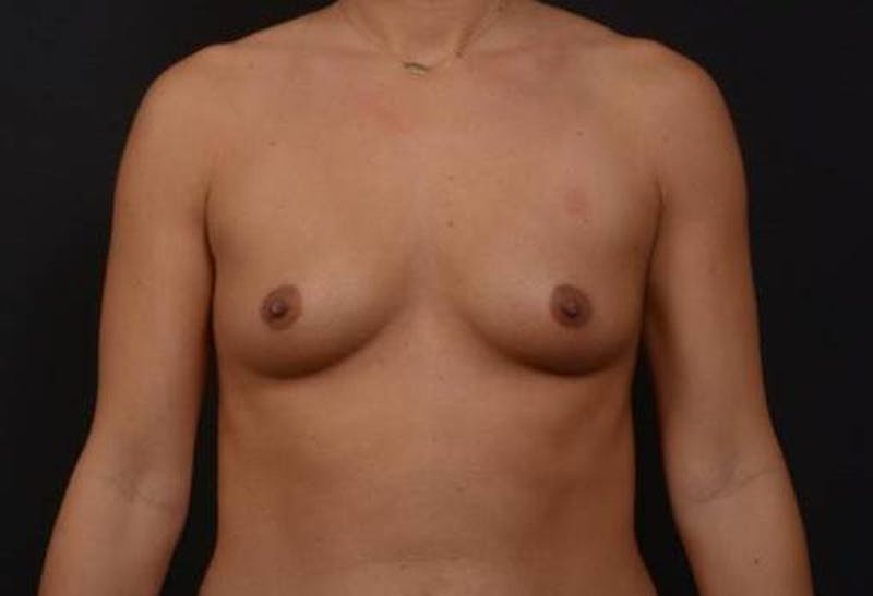 Breast Augmentation Silicone Gel Before & After Gallery - Patient 427028 - Image 1