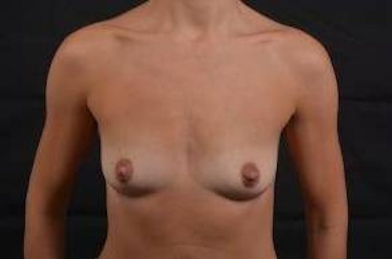 Breast Augmentation Silicone Gel Before & After Gallery - Patient 205167 - Image 1