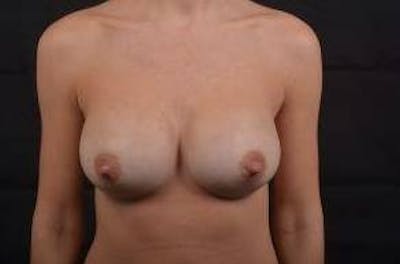 Breast Augmentation Silicone Gel Before & After Gallery - Patient 205167 - Image 2
