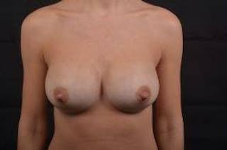 Breast Augmentation Silicone Gel Before & After Gallery - Patient 205167 - Image 2