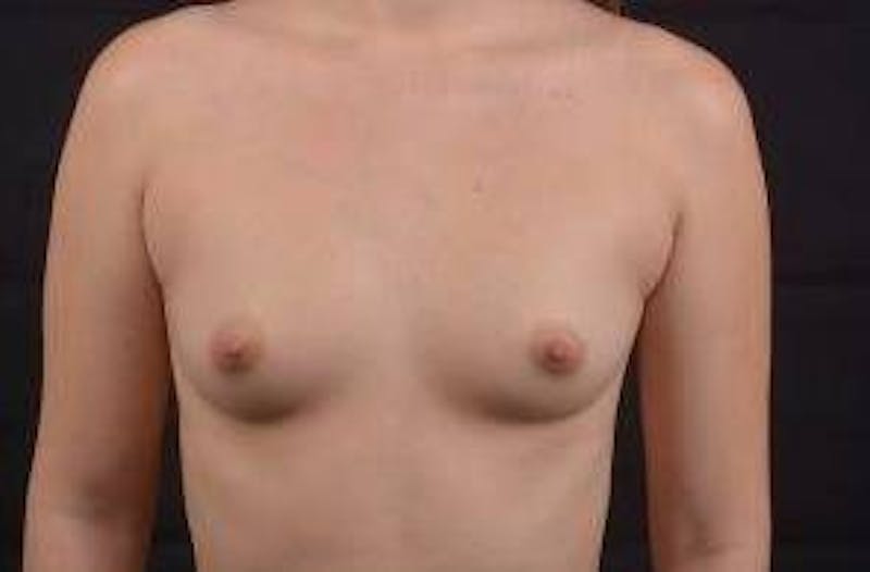 Breast Augmentation Silicone Gel Before & After Gallery - Patient 408071 - Image 1
