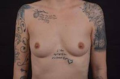 Breast Augmentation Silicone Gel Before & After Gallery - Patient 142438 - Image 1