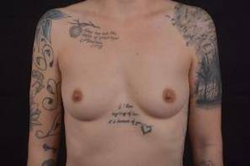 Breast Augmentation Silicone Gel Before & After Gallery - Patient 142438 - Image 1