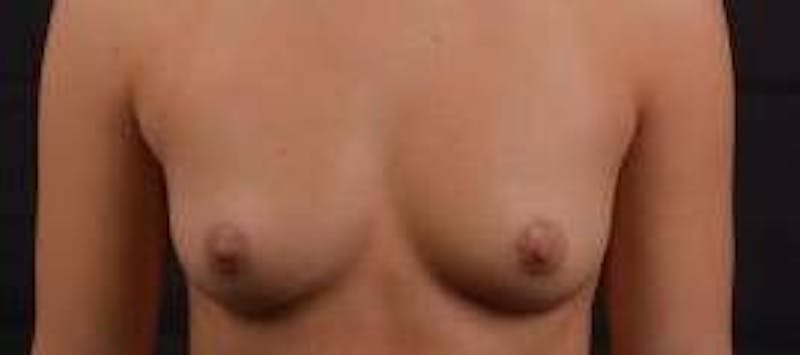 Breast Augmentation Silicone Gel Before & After Gallery - Patient 398485 - Image 1