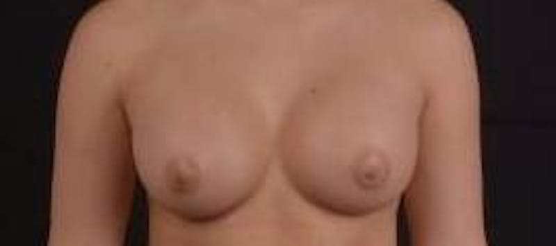 Breast Augmentation Silicone Gel Before & After Gallery - Patient 398485 - Image 2