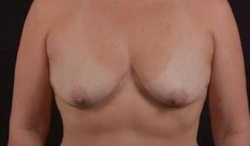 Breast Augmentation Silicone Gel Before & After Gallery - Patient 288479 - Image 1