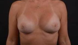Breast Augmentation Silicone Gel Before & After Gallery - Patient 288479 - Image 2