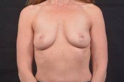 Breast Augmentation Silicone Gel Before & After Gallery - Patient 754433 - Image 1