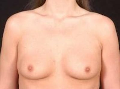 Breast Augmentation Silicone Gel Before & After Gallery - Patient 377391 - Image 1