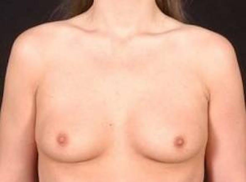 Breast Augmentation Silicone Gel Before & After Gallery - Patient 377391 - Image 1