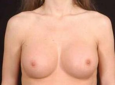 Breast Augmentation Silicone Gel Before & After Gallery - Patient 377391 - Image 2