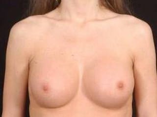 Breast Augmentation Silicone Gel Before & After Gallery - Patient 377391 - Image 2