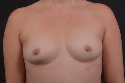 Breast Augmentation Silicone Gel Before & After Gallery - Patient 535977 - Image 1
