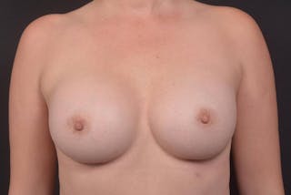Breast Augmentation Silicone Gel Before & After Gallery - Patient 535977 - Image 2
