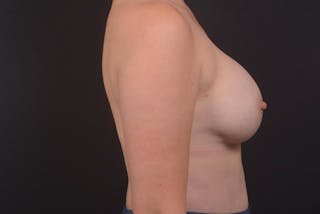 Breast Augmentation Silicone Gel Before & After Gallery - Patient 535977 - Image 6