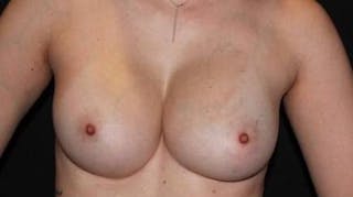 Breast Augmentation Silicone Gel Before & After Gallery - Patient 518909 - Image 2